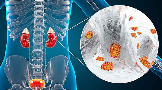 透视人体肾病肾衰竭疾病场景设计图片
