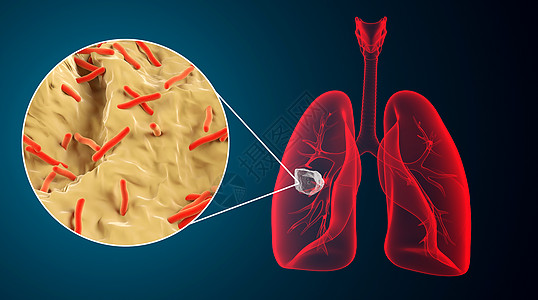 3dc肺部疾病场景设计图片