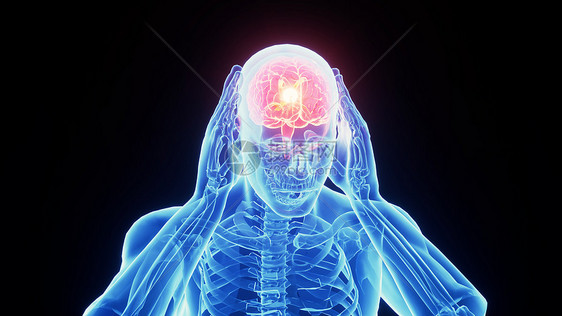 3D脑部疾病图片