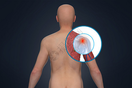 3D肩周炎场景背景图片