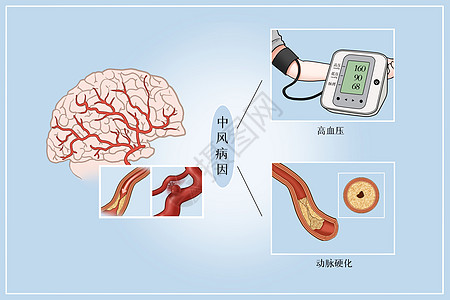 中风病因医疗插画图片