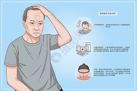 雄激素性秃发治疗方法医疗插画图片