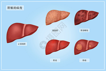 肝脏的病变医疗插画背景图片