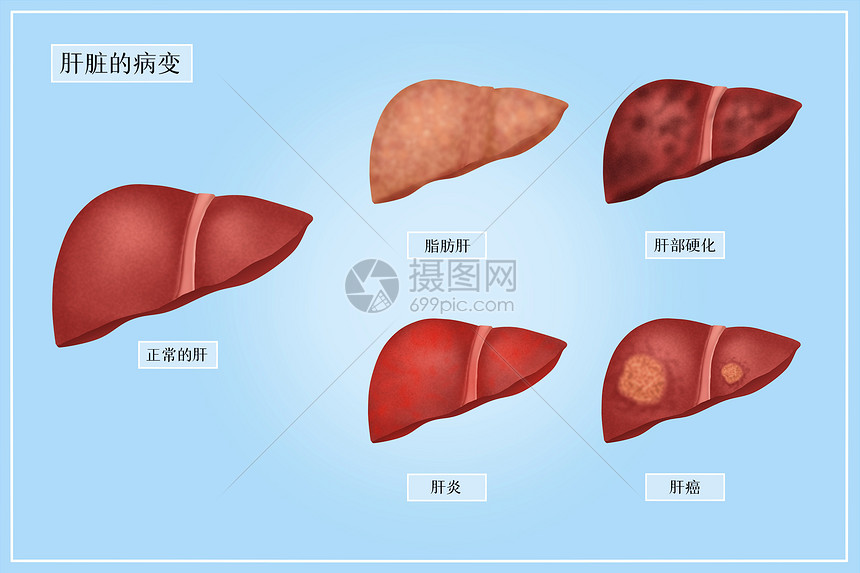 肝脏的病变医疗插画图片