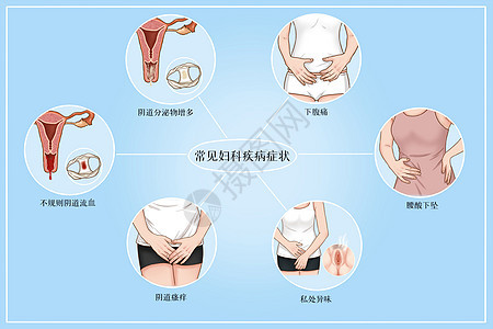 常见妇科疾病症状医疗插画图片