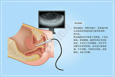 阴式B超医疗插画图片