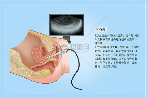 阴式B超医疗插画图片