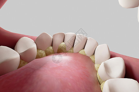 三维牙结石背景图片