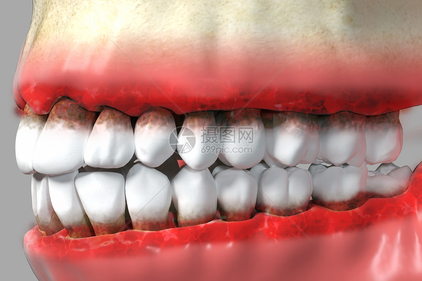 三维牙龈炎疾病背景图片