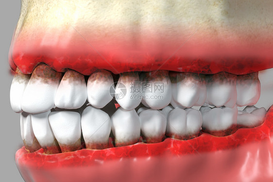 三维牙龈炎疾病背景图片