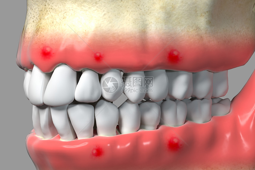 三维牙周病背景图片