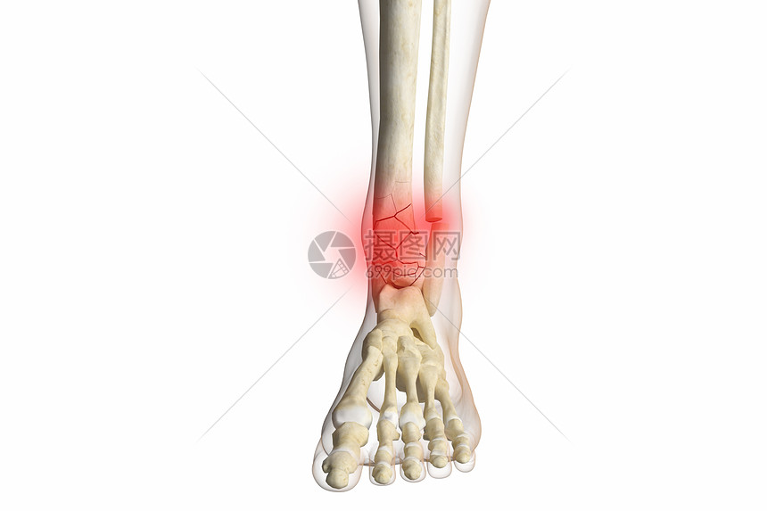 三维胫骨骨折场景图片