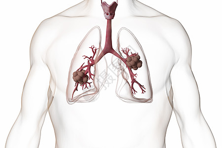 三维肺结核场景图片