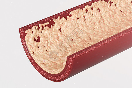 三维动脉粥样硬化剖面模型图片
