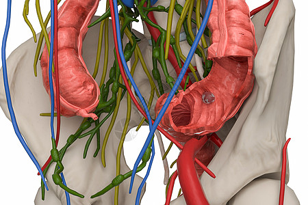 直肠大肠癌场景设计图片