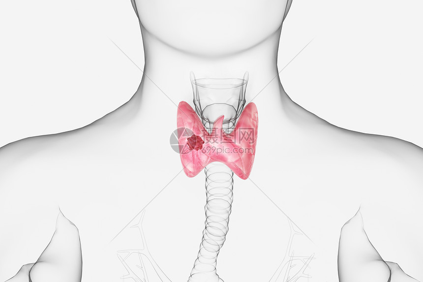 甲状腺结节图片