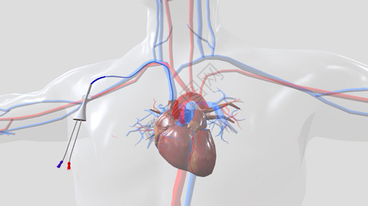 心脏导管外部固定位置背景图片