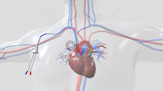 心脏导管外部固定位置图片