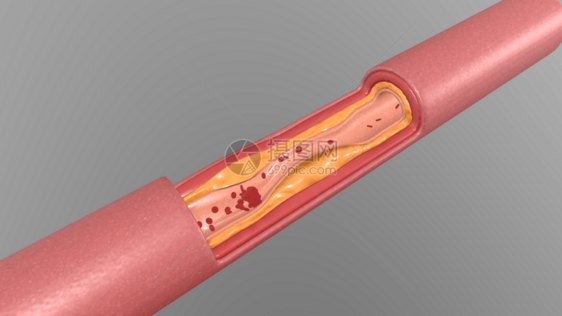 三维血管堵塞场景图片