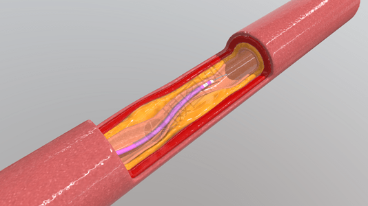 三维血管支架放置过程图片