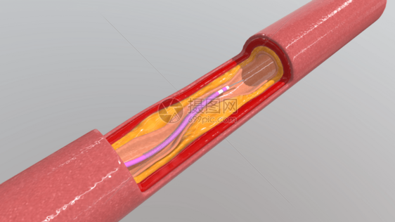 三维血管支架放置过程图片