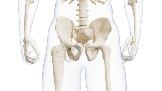 佩吉特骨病骨头变形高清图片