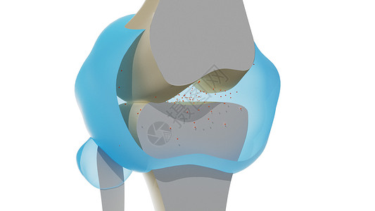 组织水平炎症(膝盖累风湿性关节炎）（动画）高清图片
