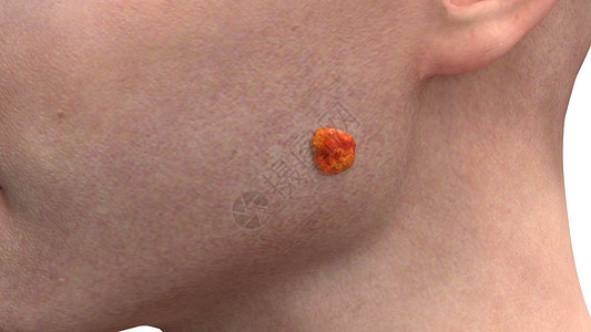 面部基底细胞癌一期图片