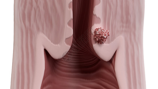 子宫颈癌第一期背景图片