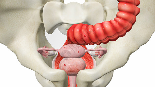 直肠子宫内膜异位症设计图片