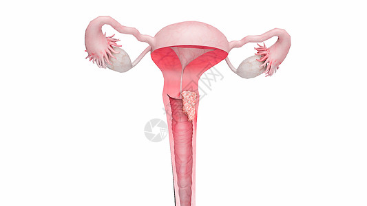 子宫颈癌二期图片