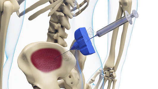 骨髓抽吸人体模型活检高清图片