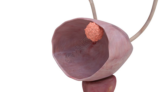膀胱癌2期肿瘤高清图片
