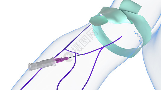 静脉注射放下套管图片