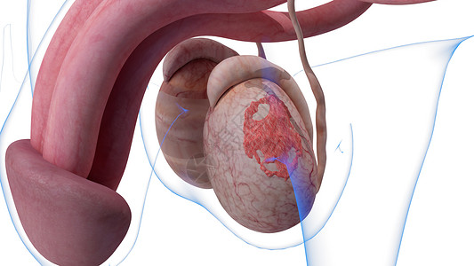 阴囊癌图片图片