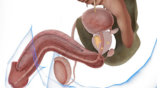 第三期前列腺癌图片