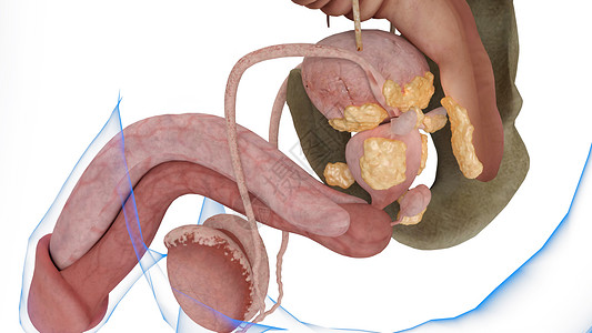 第四期前列腺癌图片