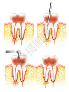 白色背景的牙科根部运河恶化说明图示图片
