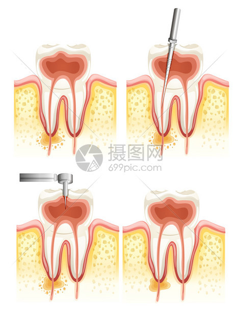 白色背景的牙科根部运河恶化说明图示图片