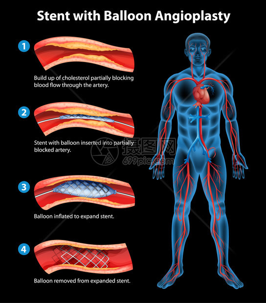 支架血管成形术图示图片