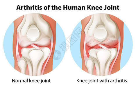 白色背景的人体膝关节炎说明背景图片