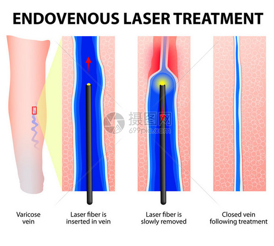 静脉曲张静脉内激光治疗激光纤维通过一个小切口插入静脉导管将激光热量传递到静脉壁图片
