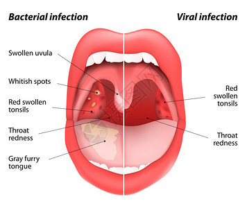 感染和细菌感染的区别扁桃体张开嘴视图由或细菌感染引起的扁桃体疾病炎背景图片
