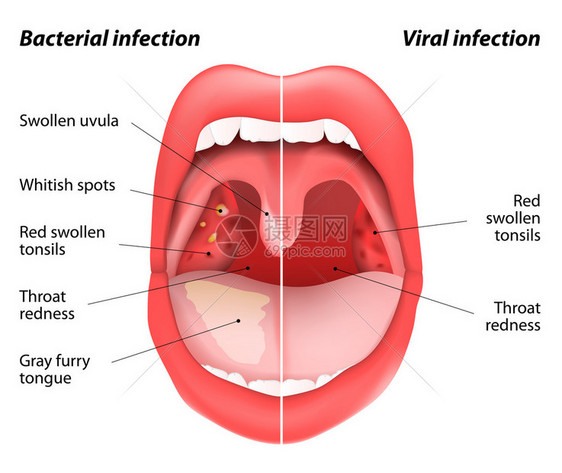 感染和细菌感染的区别扁桃体张开嘴视图由或细菌感染引起的扁桃体疾病炎图片