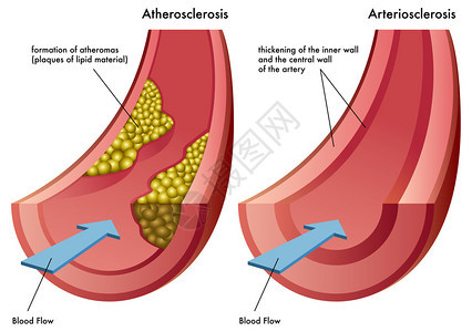 动脉硬化的过程图片