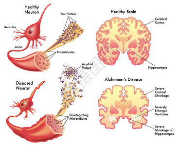 阿尔茨海默病背景图片