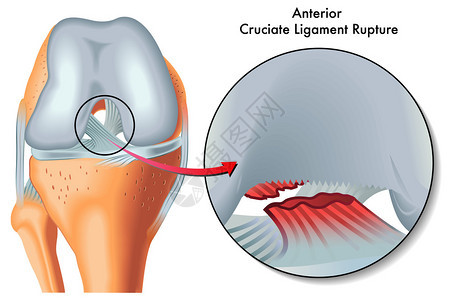 前交叉韧带断裂图片