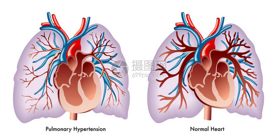 描绘肺动脉高压的艺术品图片