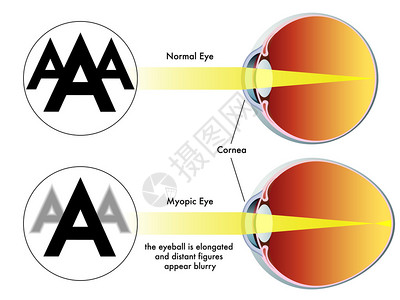 屈光不正色彩多的近视插画