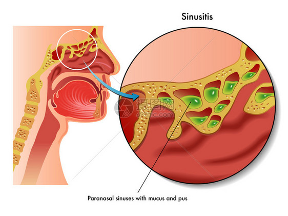 白色背景下的人类鼻窦炎方案图片